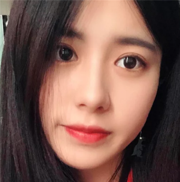 上海愉悦美联臣汪泽群鼻部手术怎么样?价格案例
