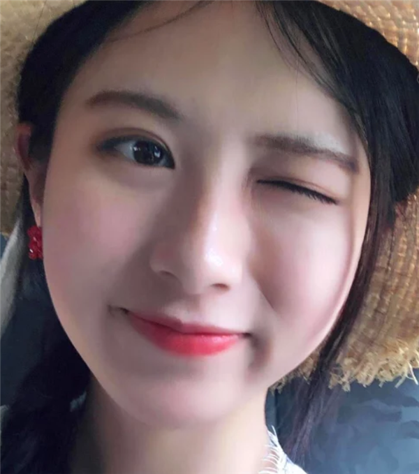 上海愉悦美联臣汪泽群鼻部手术怎么样?价格案例
