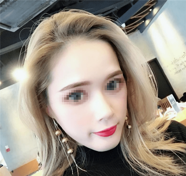 长沙中欧亚太廖小翠脂肪丰太阳穴怎么样?