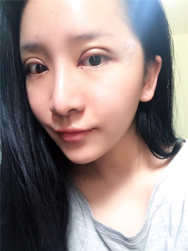无锡丽都医院陈光平双眼皮怎么样?价格案例
