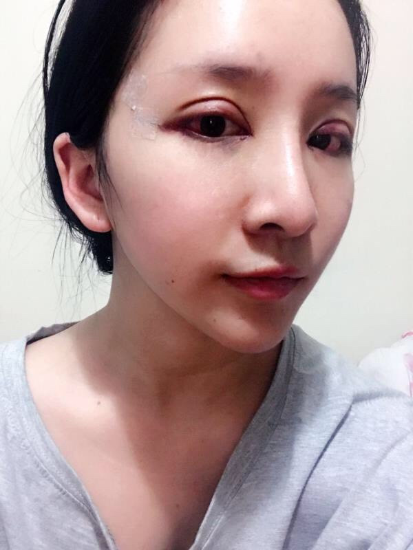 无锡丽都医院陈光平双眼皮怎么样?价格案例