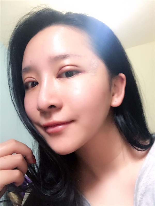 无锡丽都医院陈光平双眼皮怎么样?价格案例