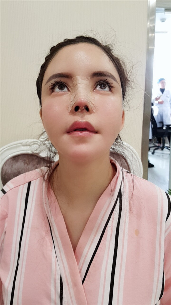 上海喜美王会勇隆鼻鼻修复怎么样?价格案例