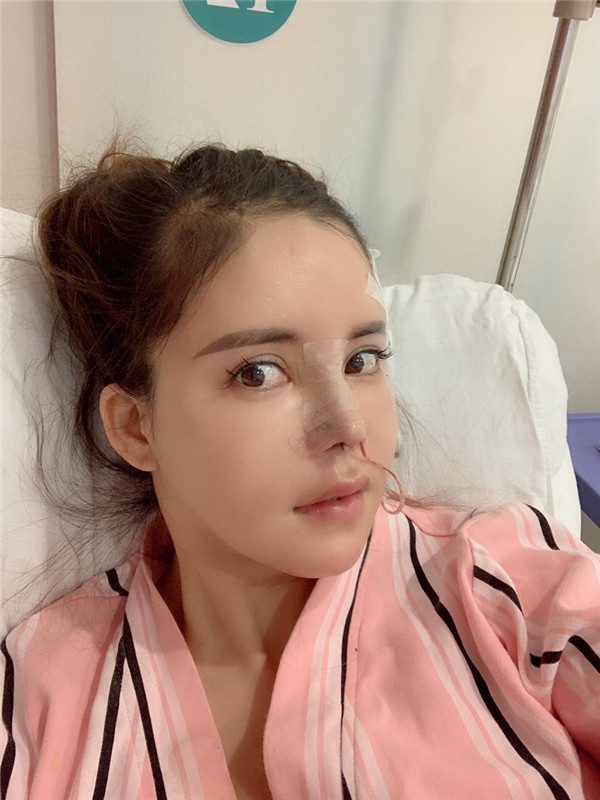 上海喜美王会勇隆鼻鼻修复怎么样?价格案例