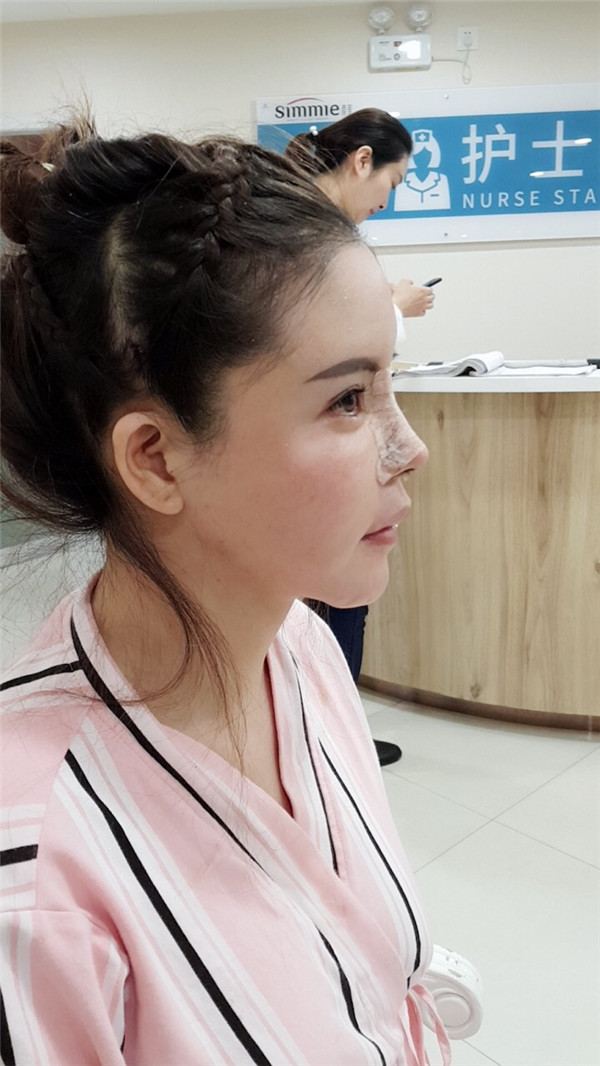 上海喜美王会勇隆鼻鼻修复怎么样?价格案例