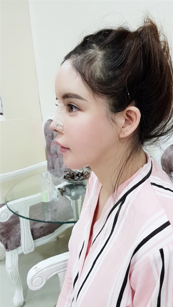 上海喜美王会勇隆鼻鼻修复怎么样?价格案例