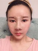 贵州利美康张凯隆鼻怎么样？价格案例