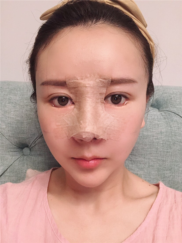 贵州利美康张凯隆鼻怎么样?价格案例