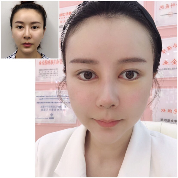 贵州利美康张凯隆鼻怎么样?价格案例