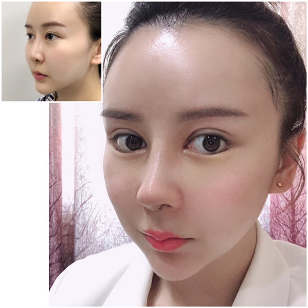 贵州利美康张凯隆鼻怎么样?价格案例