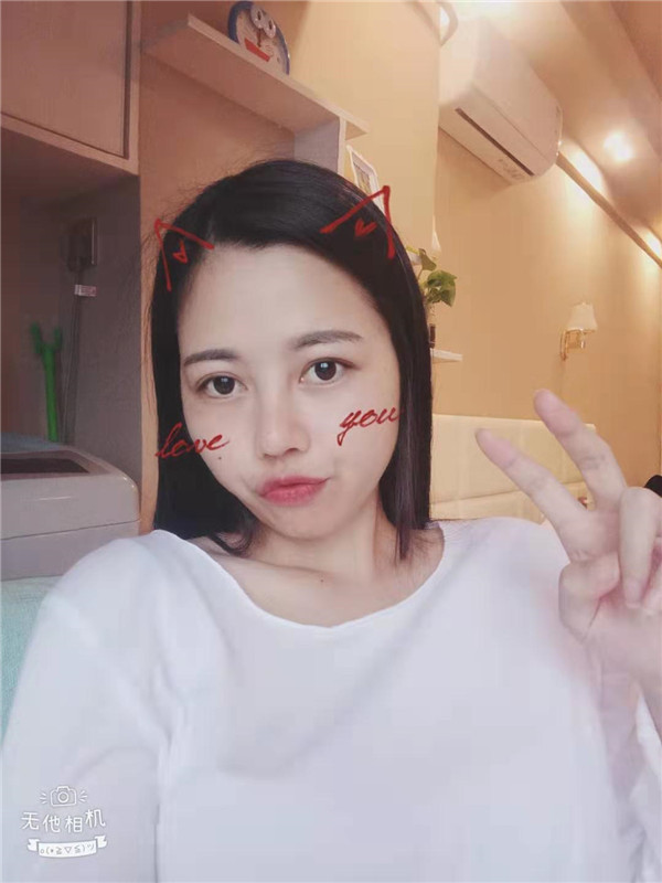 福州格莱美周秀峰隆鼻怎么样?价格案例