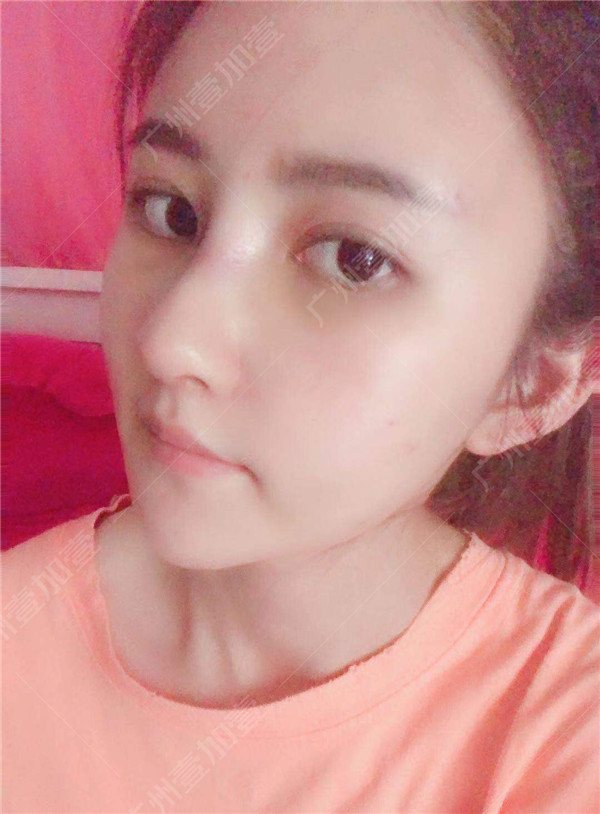 广州壹加壹李明隆鼻怎么样?价格案例