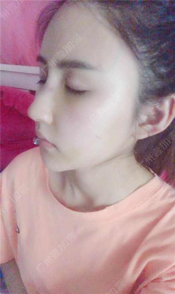 广州壹加壹李明隆鼻怎么样?价格案例
