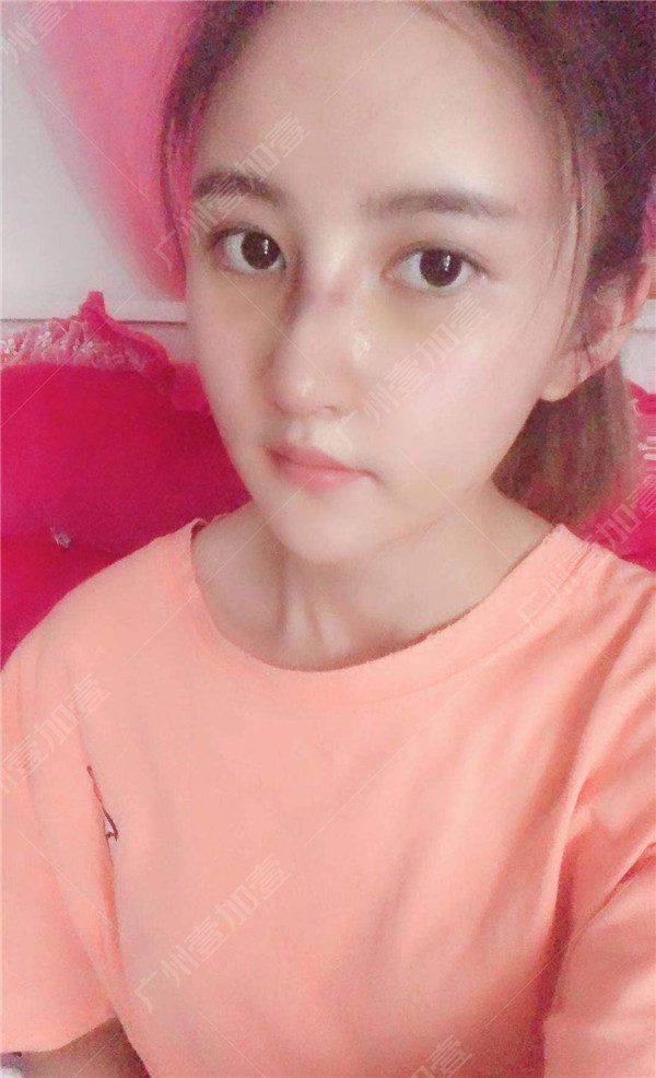 广州壹加壹李明隆鼻怎么样?价格案例