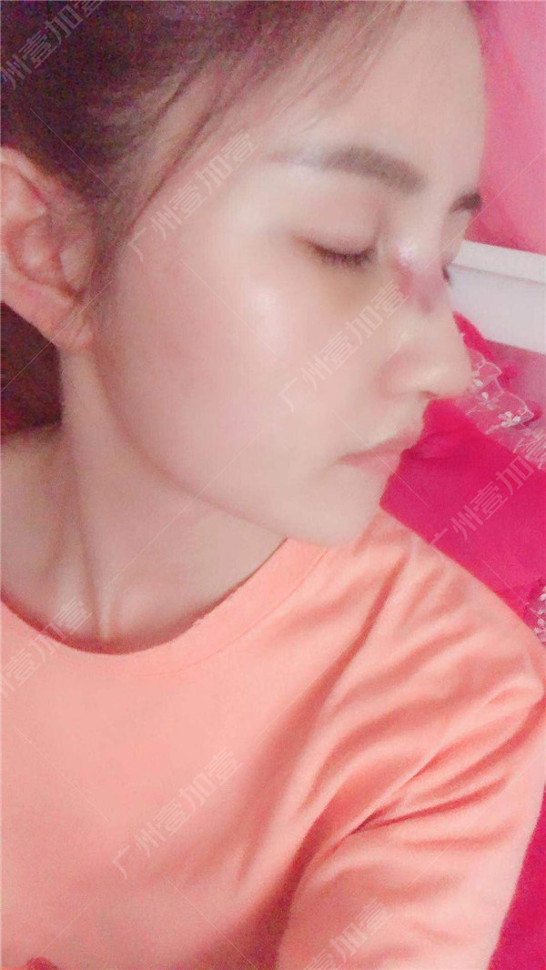 广州壹加壹李明隆鼻怎么样?价格案例