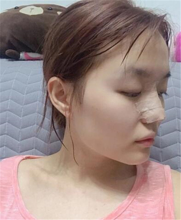 南昌佳美周方宾鼻部手术怎么样?价格案例