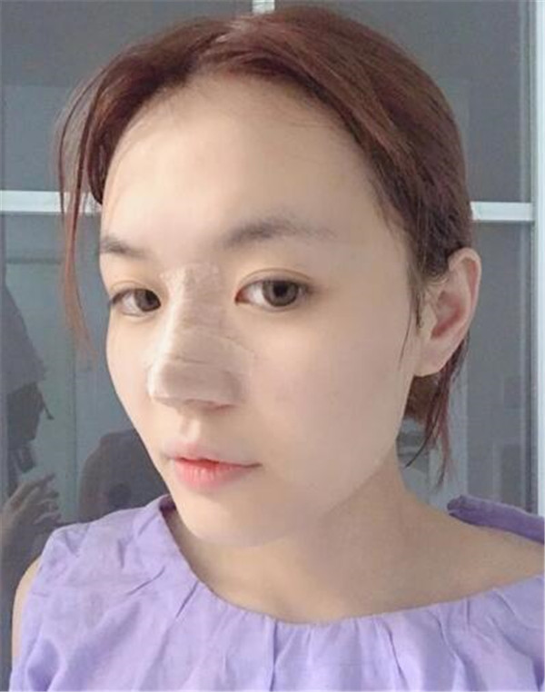 南昌佳美周方宾鼻部手术怎么样?价格案例
