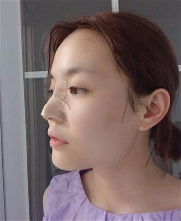 南昌佳美周方宾鼻部手术怎么样?价格案例