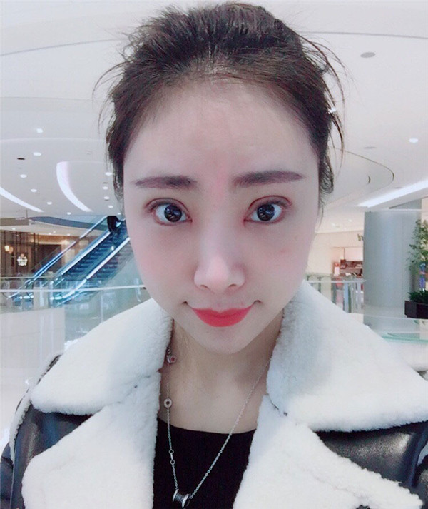 上海悦莱眼部手术怎么样?价格案例