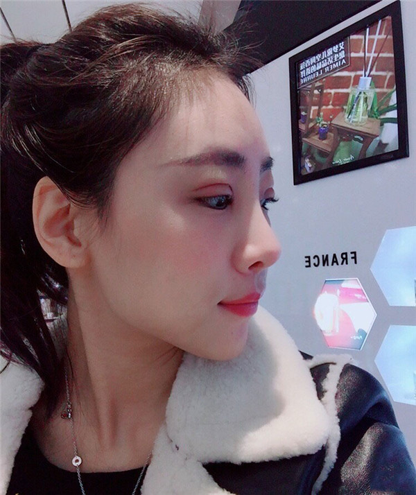 上海悦莱眼部手术怎么样?价格案例