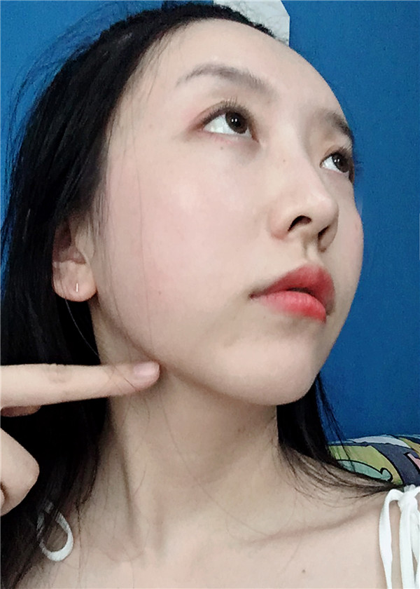 金陵嘉怡美吸脂怎么样?价格案例