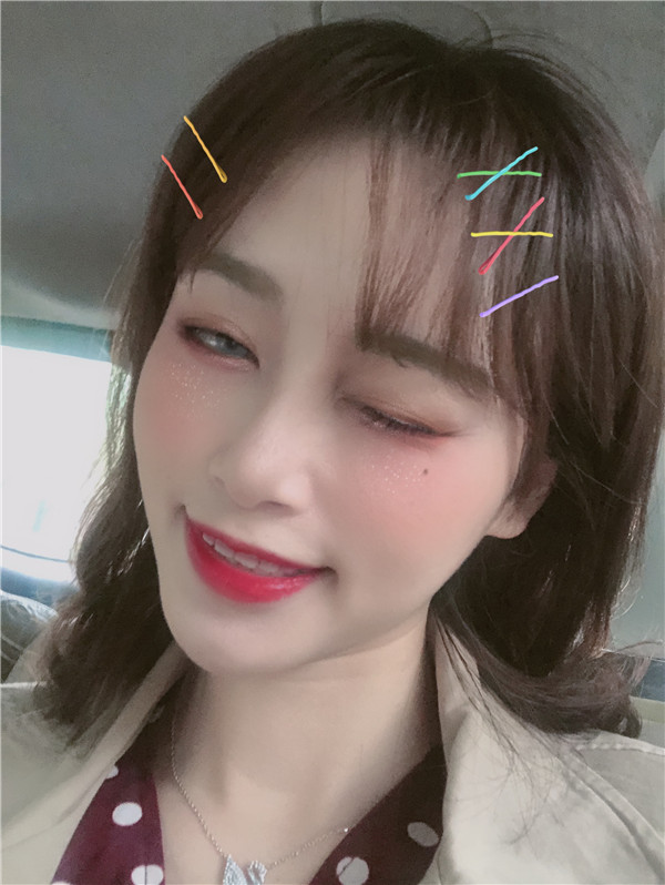 杭州艾尔莎奥拉克双眼皮怎么样?价格案例
