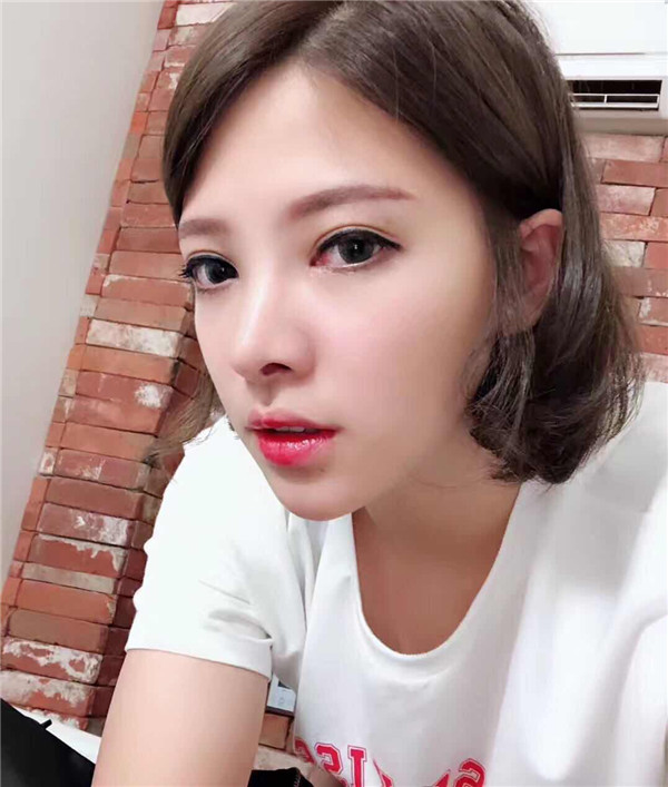 重庆联合丽格双眼皮怎么样?价格案例
