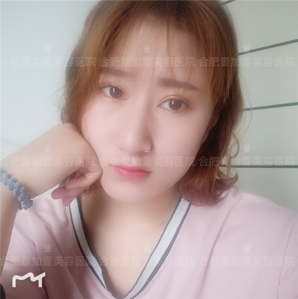 合肥壹加壹眼部手术怎么样?价格案例