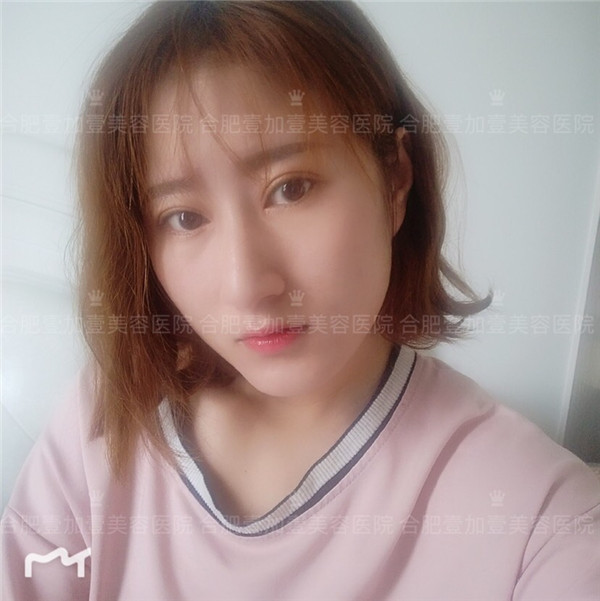 合肥壹加壹眼部手术怎么样?价格案例