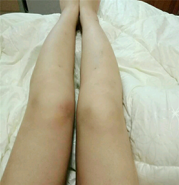 哈尔滨韩美大腿吸脂怎么样?价格案例