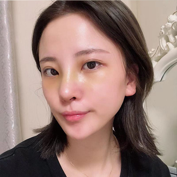 武汉奥黛丽隆鼻怎么样?价格案例