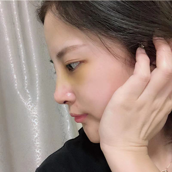 武汉奥黛丽隆鼻怎么样?价格案例