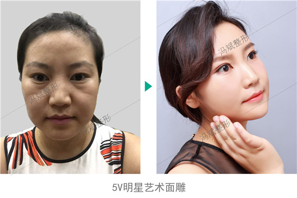 北京东方和谐冯斌脂肪填充怎么样