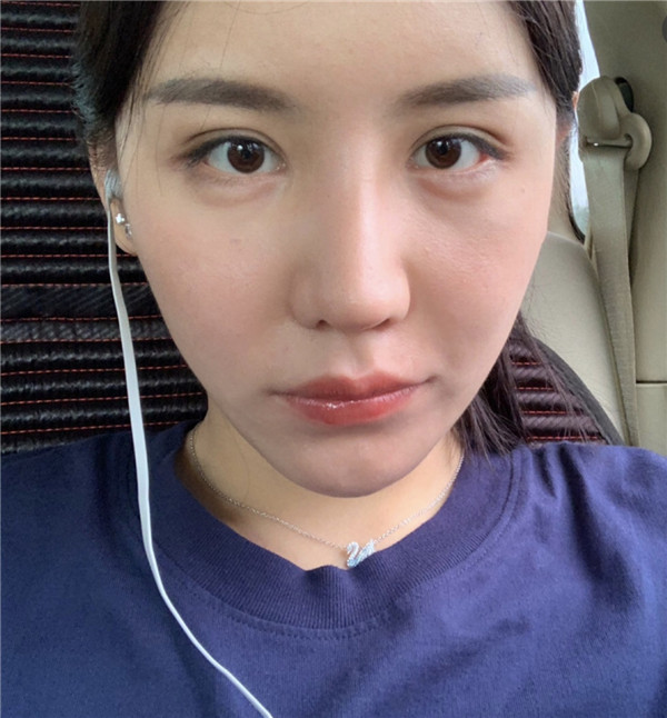北京凯润婷隆鼻怎么样?