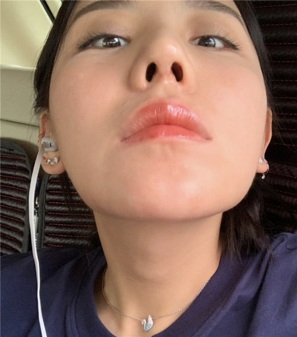北京凯润婷隆鼻怎么样?