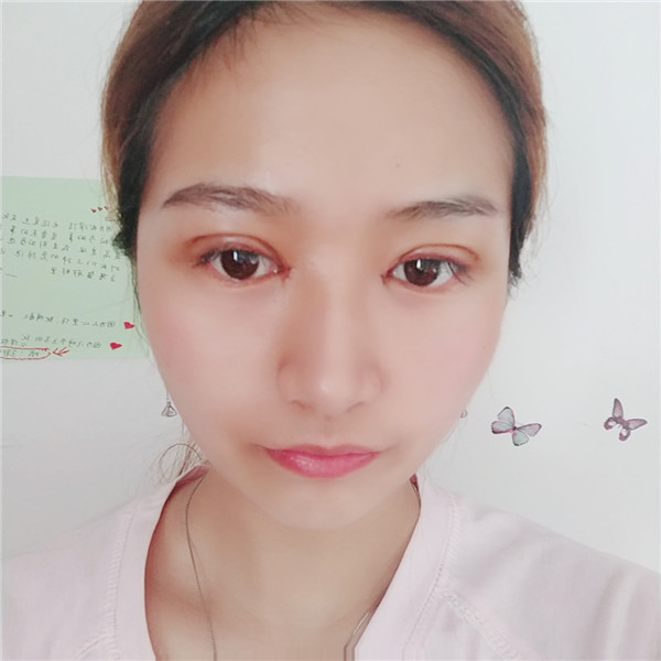 南京柠檬割双眼皮怎么样?