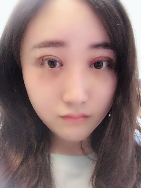 北京玲珑梵宫双眼皮怎么样?