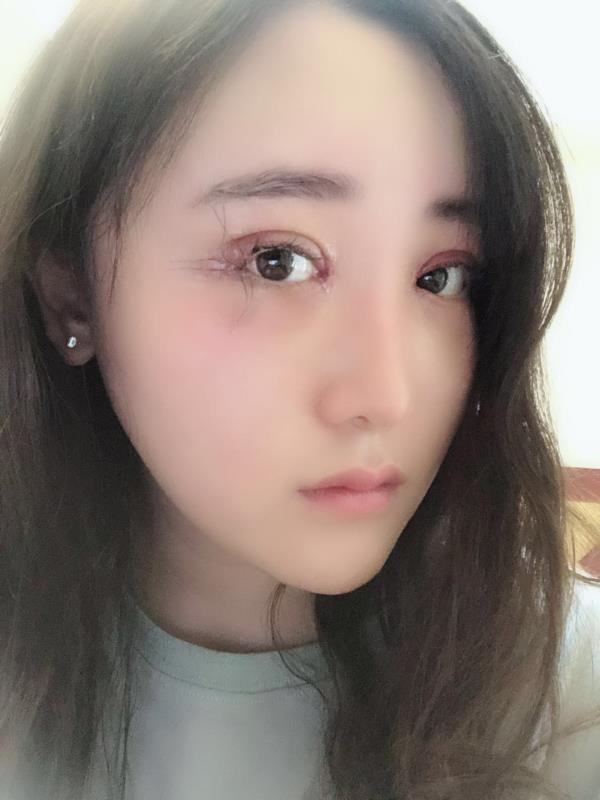 北京玲珑梵宫双眼皮怎么样?