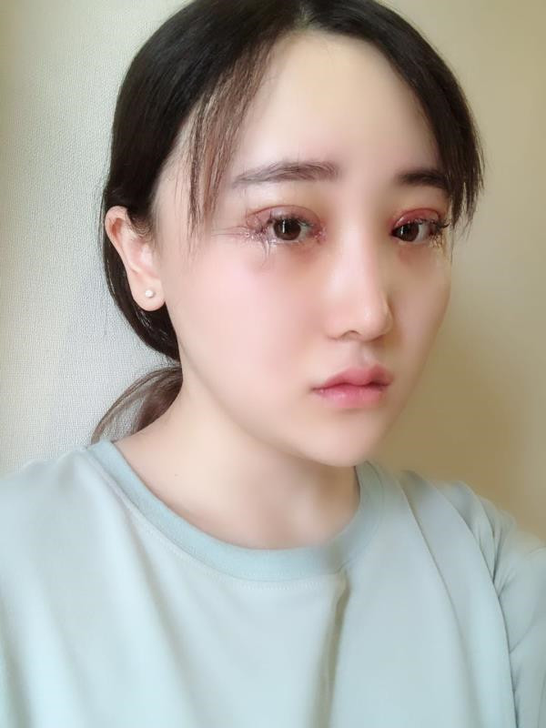 北京玲珑梵宫双眼皮怎么样?