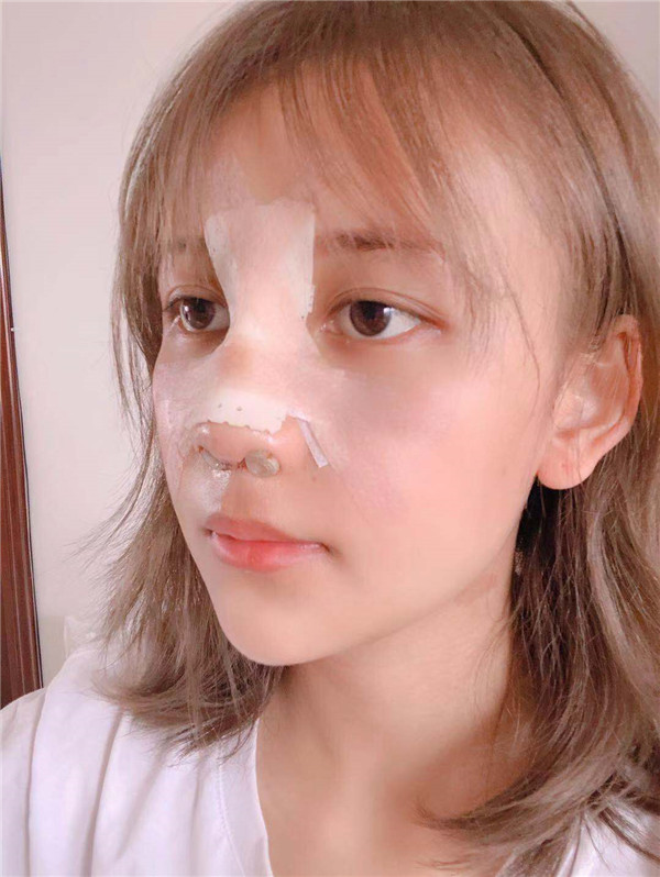 云南华美美莱隆鼻怎么样?