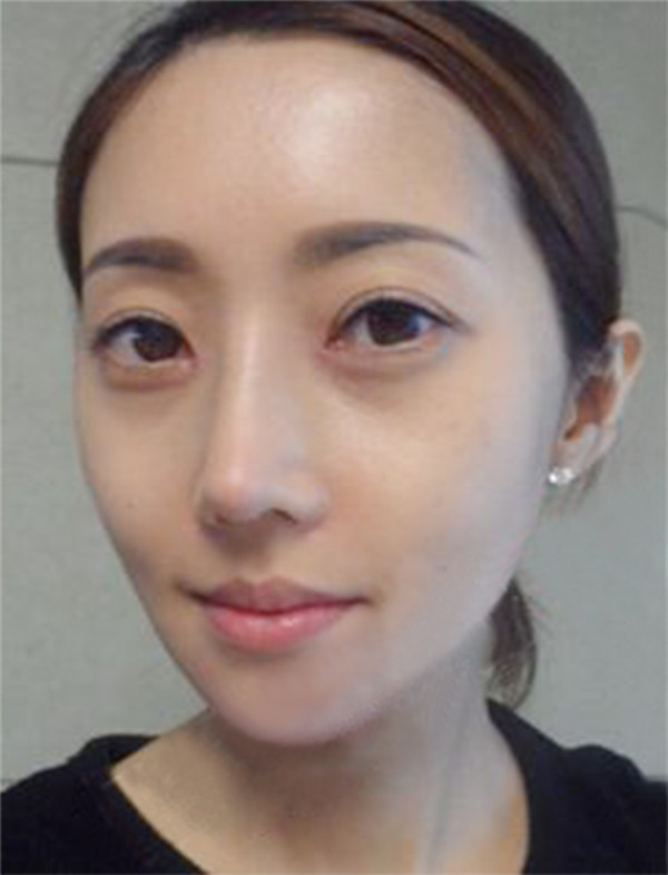 青岛元美隆鼻怎么样?