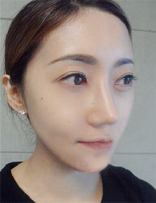 青岛元美隆鼻怎么样?