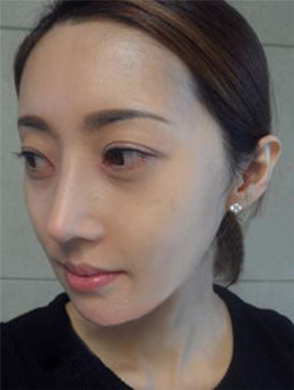 青岛元美隆鼻怎么样?
