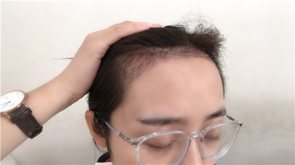 北京南加植发怎么样?