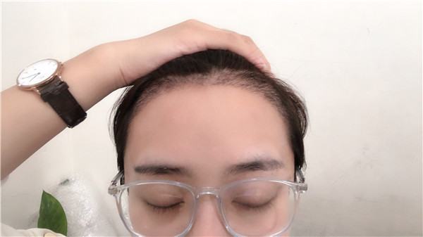 北京南加植发怎么样?