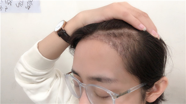 北京南加植发怎么样?