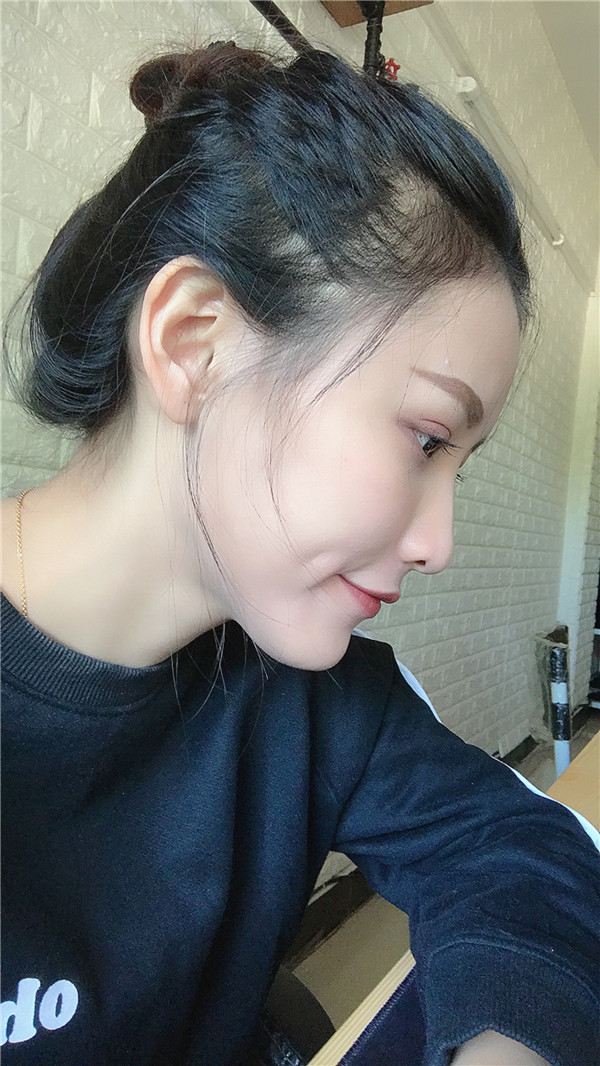 苏州卫康脂肪填充怎么样?
