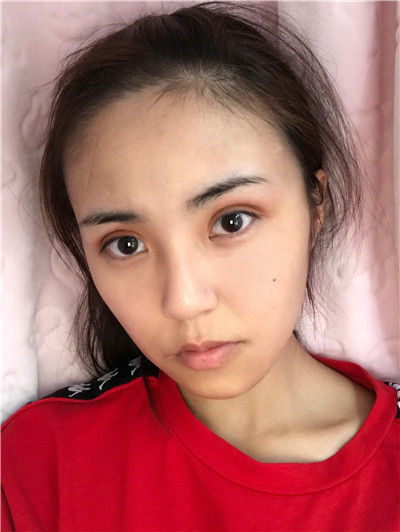 广东画美切开双眼皮怎么样
