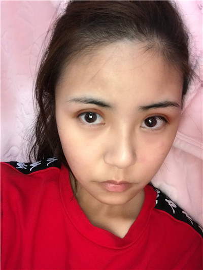 广东画美切开双眼皮怎么样