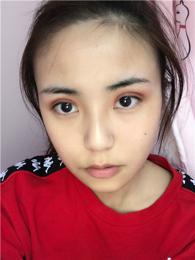 广东画美切开双眼皮怎么样